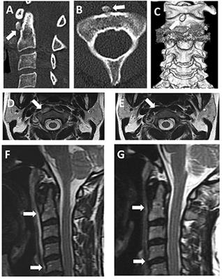 Two rare diseases, acute calcific retropharyngeal tendinitis, and crowned dens syndrome, mimicking meningitis: A case report